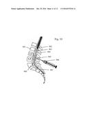 METHODS AND SYSTEM FOR ULTRASONIC TARGETED DRUG DELIVERY IN CYSTIC FLUIDS,     SUCH AS THE CEREBROSPINAL FLUID, USING BUOYANCY SPECIFIC DRUG CARRIERS diagram and image