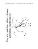 UNWRAPPED 2D VIEW OF A STIMULATION LEADWITH COMPLEX ELECTRODE ARRAY     GEOMETRY diagram and image