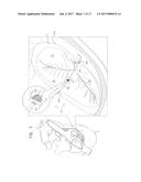 SUTURE-SECURING FOR CARDIAC VALVE REPAIR diagram and image