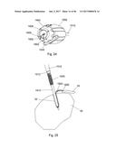 CERAMIC IMPLANT PLACEMENT SYSTEMS AND SUPERELASTIC SUTURE RETENTION LOOPS     FOR USE THEREWITH diagram and image