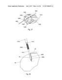 CERAMIC IMPLANT PLACEMENT SYSTEMS AND SUPERELASTIC SUTURE RETENTION LOOPS     FOR USE THEREWITH diagram and image