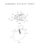 CERAMIC IMPLANT PLACEMENT SYSTEMS AND SUPERELASTIC SUTURE RETENTION LOOPS     FOR USE THEREWITH diagram and image