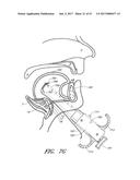 SUTURE PASSER SYSTEMS AND METHODS FOR TONGUE OR OTHER TISSUE SUSPENSION     AND COMPRESSION diagram and image