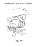 SUTURE PASSER SYSTEMS AND METHODS FOR TONGUE OR OTHER TISSUE SUSPENSION     AND COMPRESSION diagram and image