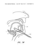 SUTURE PASSER SYSTEMS AND METHODS FOR TONGUE OR OTHER TISSUE SUSPENSION     AND COMPRESSION diagram and image