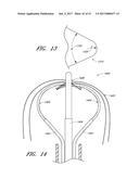 SUTURE PASSER SYSTEMS AND METHODS FOR TONGUE OR OTHER TISSUE SUSPENSION     AND COMPRESSION diagram and image