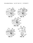 SURGICAL FILAMENT SNARE ASSEMBLIES diagram and image