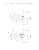 SURGICAL INSTRUMENT FOR FITTING AN OSTEOSYNTHESIS CLIP diagram and image