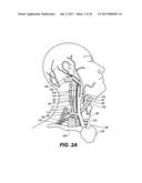 ENDOVASCULAR CATHETER WITH MULTIPLE CAPABILITIES diagram and image