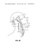 ENDOVASCULAR CATHETER WITH MULTIPLE CAPABILITIES diagram and image