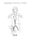 ENDOVASCULAR CATHETER WITH MULTIPLE CAPABILITIES diagram and image