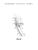 ENDOVASCULAR CATHETER WITH MULTIPLE CAPABILITIES diagram and image