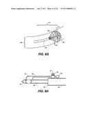 ENDOVASCULAR CATHETER WITH MULTIPLE CAPABILITIES diagram and image