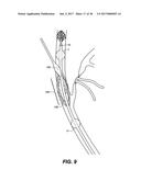 ENDOVASCULAR CATHETER WITH MULTIPLE CAPABILITIES diagram and image