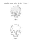 PATIENT-SPECIFIC TRACKABLE CUTTING GUIDES diagram and image