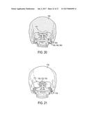 PATIENT-SPECIFIC TRACKABLE CUTTING GUIDES diagram and image