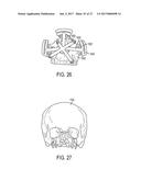 PATIENT-SPECIFIC TRACKABLE CUTTING GUIDES diagram and image