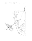 DEVICES AND METHODS FOR VERTEBROSTENTING diagram and image