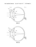 CAPSULAR MEMBRANE IMPLANTS TO INCREASE ACCOMMODATIVE AMPLITUDE diagram and image