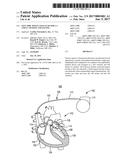 LEFT SIDE SINGLE PASS LEAD FOR LA AND LV SENSING AND PACING diagram and image