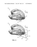 METHOD OF SCAN GEOMETRY PLANNING FOR DETERMINING WALL THICKNESS OF AN     ANATOMIC DETAIL USING MAGNETIC RESONANCE IMAGING diagram and image