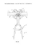 SURGICAL INSTRUMENTATION AND METHOD diagram and image