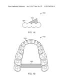 SYSTEMS, APPARATUSES AND METHODS FOR DENTAL APPLIANCES WITH INTEGRALLY     FORMED FEATURES diagram and image