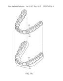 MULTI-MATERIAL ALIGNERS diagram and image