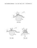 MULTI-MATERIAL ALIGNERS diagram and image