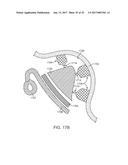 MULTI-MATERIAL ALIGNERS diagram and image