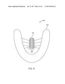 DIRECT FABRICATION OF ALIGNERS FOR ARCH EXPANSION diagram and image