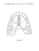 DIRECT FABRICATION OF ALIGNERS FOR ARCH EXPANSION diagram and image