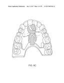 DIRECT FABRICATION OF ALIGNERS FOR ARCH EXPANSION diagram and image