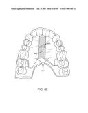 DIRECT FABRICATION OF ALIGNERS FOR ARCH EXPANSION diagram and image