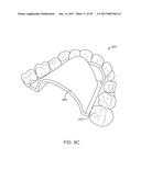 DIRECT FABRICATION OF ALIGNERS FOR ARCH EXPANSION diagram and image