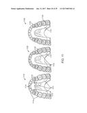 DIRECT FABRICATION OF ALIGNERS FOR ARCH EXPANSION diagram and image