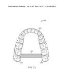 DIRECT FABRICATION OF ALIGNERS FOR ARCH EXPANSION diagram and image