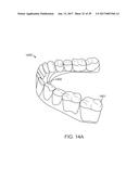 DIRECT FABRICATION OF ALIGNERS FOR ARCH EXPANSION diagram and image