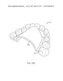 DIRECT FABRICATION OF ALIGNERS FOR ARCH EXPANSION diagram and image