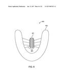 DIRECT FABRICATION OF ALIGNERS FOR PALATE EXPANSION AND OTHER APPLICATIONS diagram and image