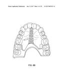 DIRECT FABRICATION OF ALIGNERS FOR PALATE EXPANSION AND OTHER APPLICATIONS diagram and image