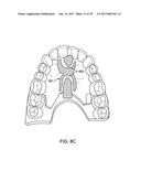 DIRECT FABRICATION OF ALIGNERS FOR PALATE EXPANSION AND OTHER APPLICATIONS diagram and image