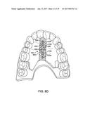 DIRECT FABRICATION OF ALIGNERS FOR PALATE EXPANSION AND OTHER APPLICATIONS diagram and image