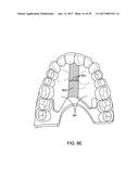 DIRECT FABRICATION OF ALIGNERS FOR PALATE EXPANSION AND OTHER APPLICATIONS diagram and image