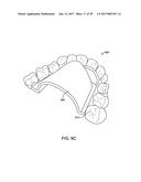 DIRECT FABRICATION OF ALIGNERS FOR PALATE EXPANSION AND OTHER APPLICATIONS diagram and image