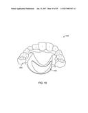 DIRECT FABRICATION OF ALIGNERS FOR PALATE EXPANSION AND OTHER APPLICATIONS diagram and image