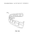 DIRECT FABRICATION OF ALIGNERS FOR PALATE EXPANSION AND OTHER APPLICATIONS diagram and image