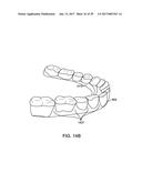 DIRECT FABRICATION OF ALIGNERS FOR PALATE EXPANSION AND OTHER APPLICATIONS diagram and image