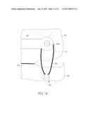 METHOD OF DESIGNING A MANDIBULAR ADVANCEMENT DEVICE AND MANDIBULAR     ADVANCEMENT DEVICE diagram and image