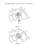 METHODS FOR TAKING AN IMPRESSION OR SCANNING WITHOUT REQUIRING REMOVAL OF     A TEMPORARY HEALING ABUTMENT diagram and image